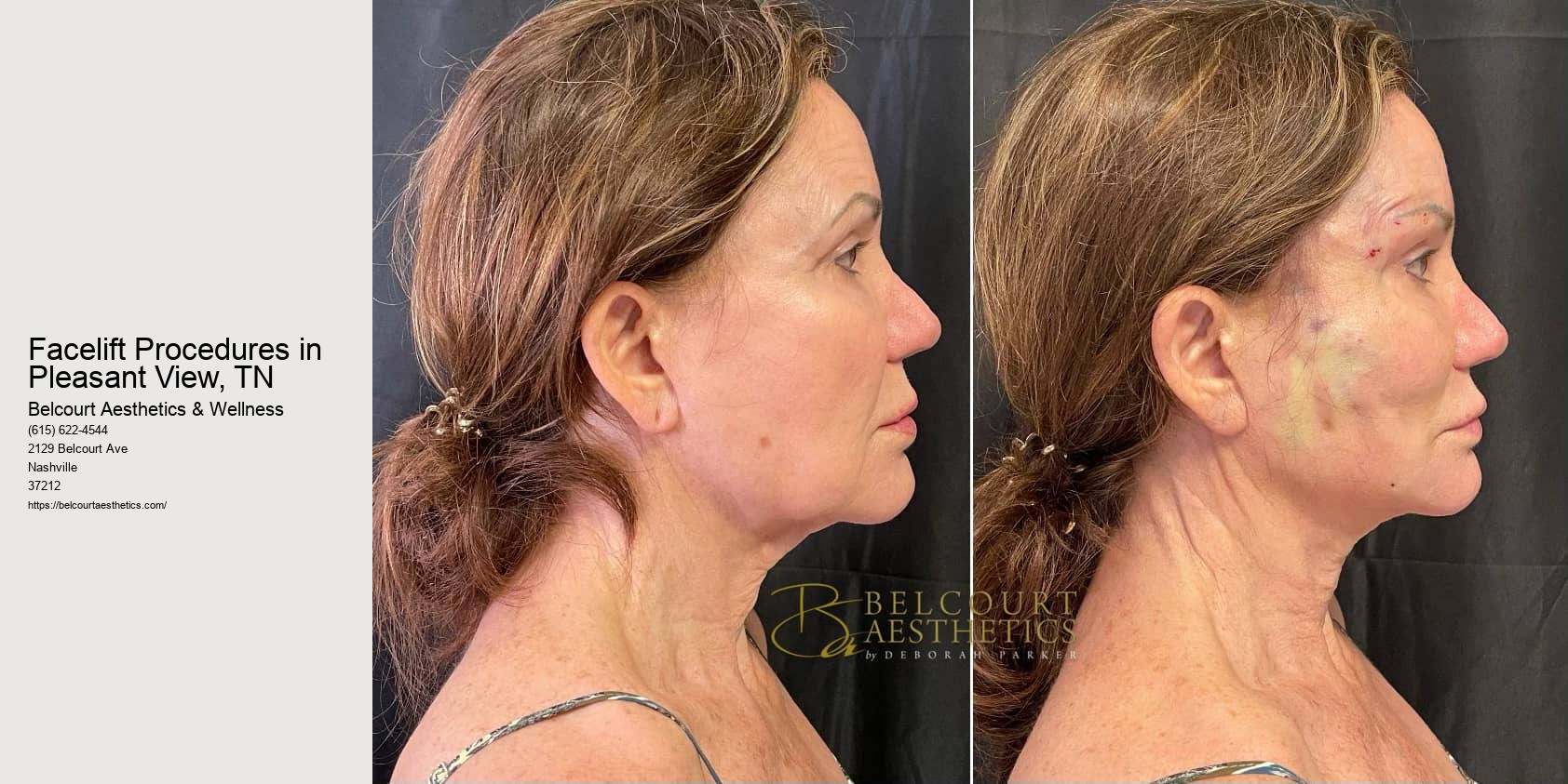 Facelift Procedures in Pleasant View, TN